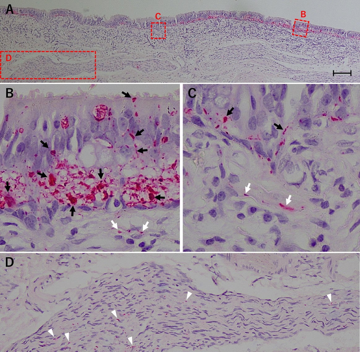 A Histochemical Analysis of Neurofibrillary Tangles in Olfactory Epithelium, a Study Based on an Autopsy Case of Juvenile Alzheimer’s Disease