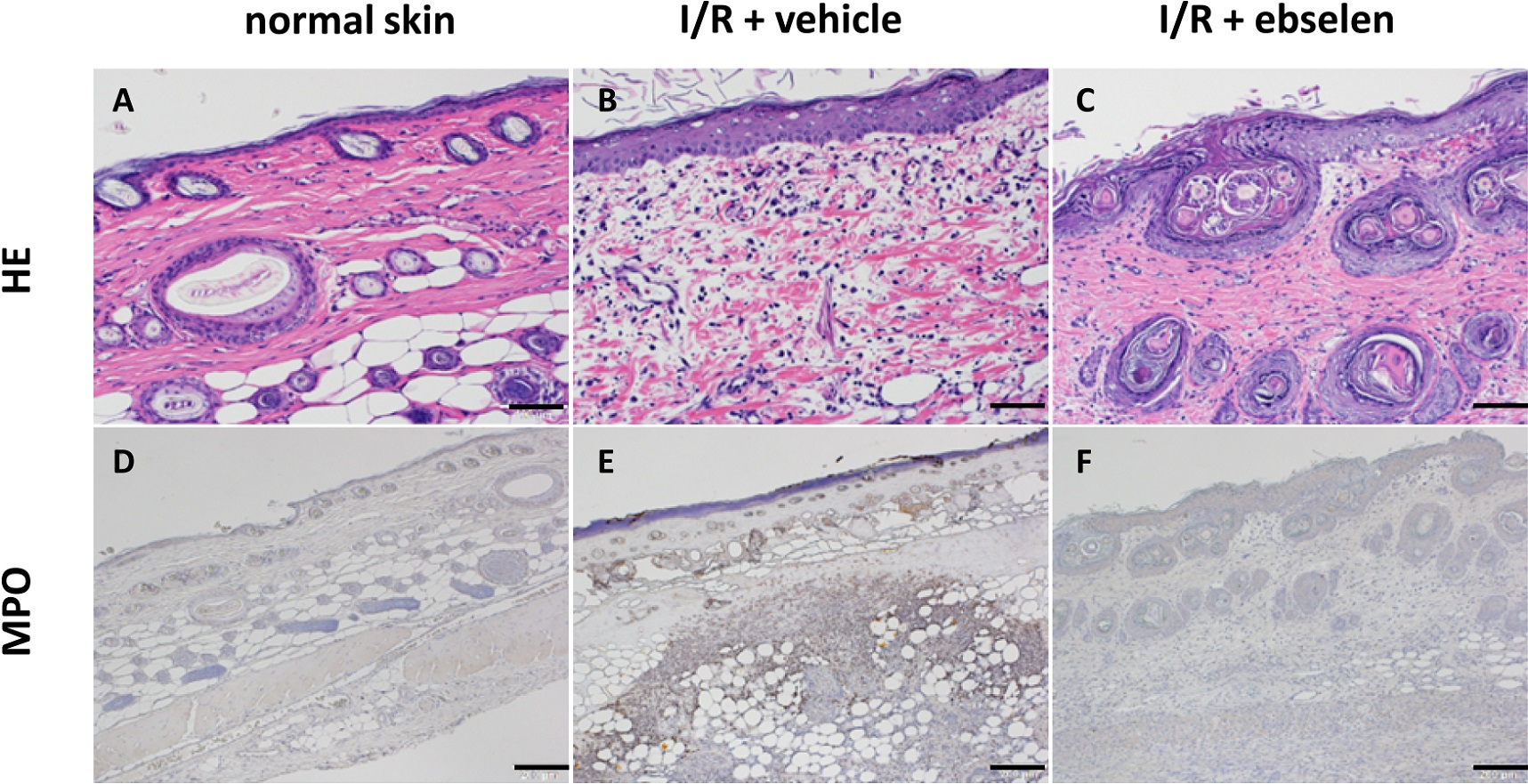 Protective Effect of Ebselen on Ischemia-reperfusion Injury in Epigastric Skin Flaps in Rats