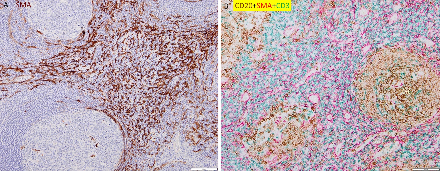 C-C Chemokine 21-Expressing T-cell Zone Fibroblastic Reticular Cells, Abundant in Lymph Nodes, Are Absent in Cancer Lymphoid Stroma