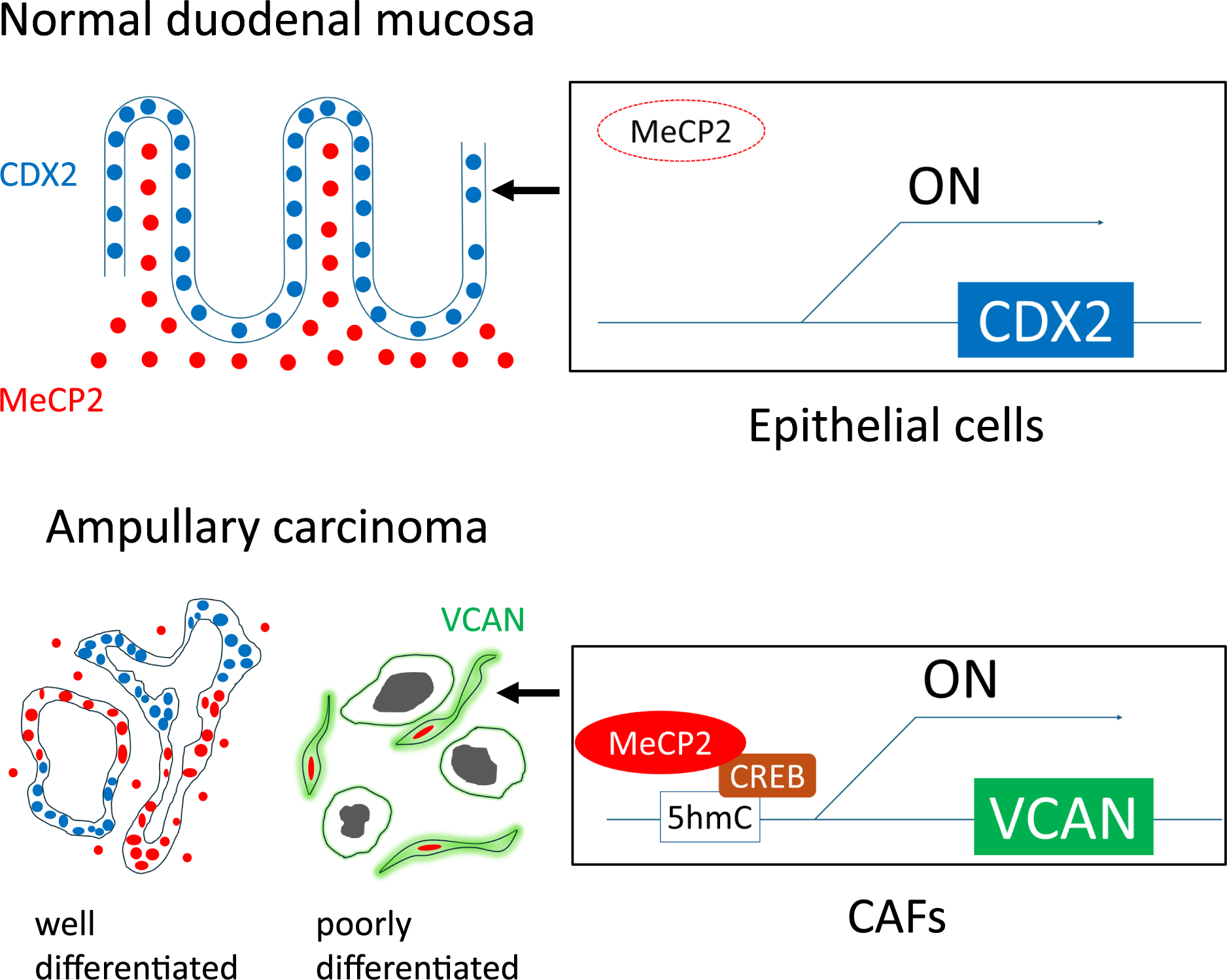 Role of MeCP2 in Shaping the Histopathological Heterogeneity of Ampullary Carcinoma