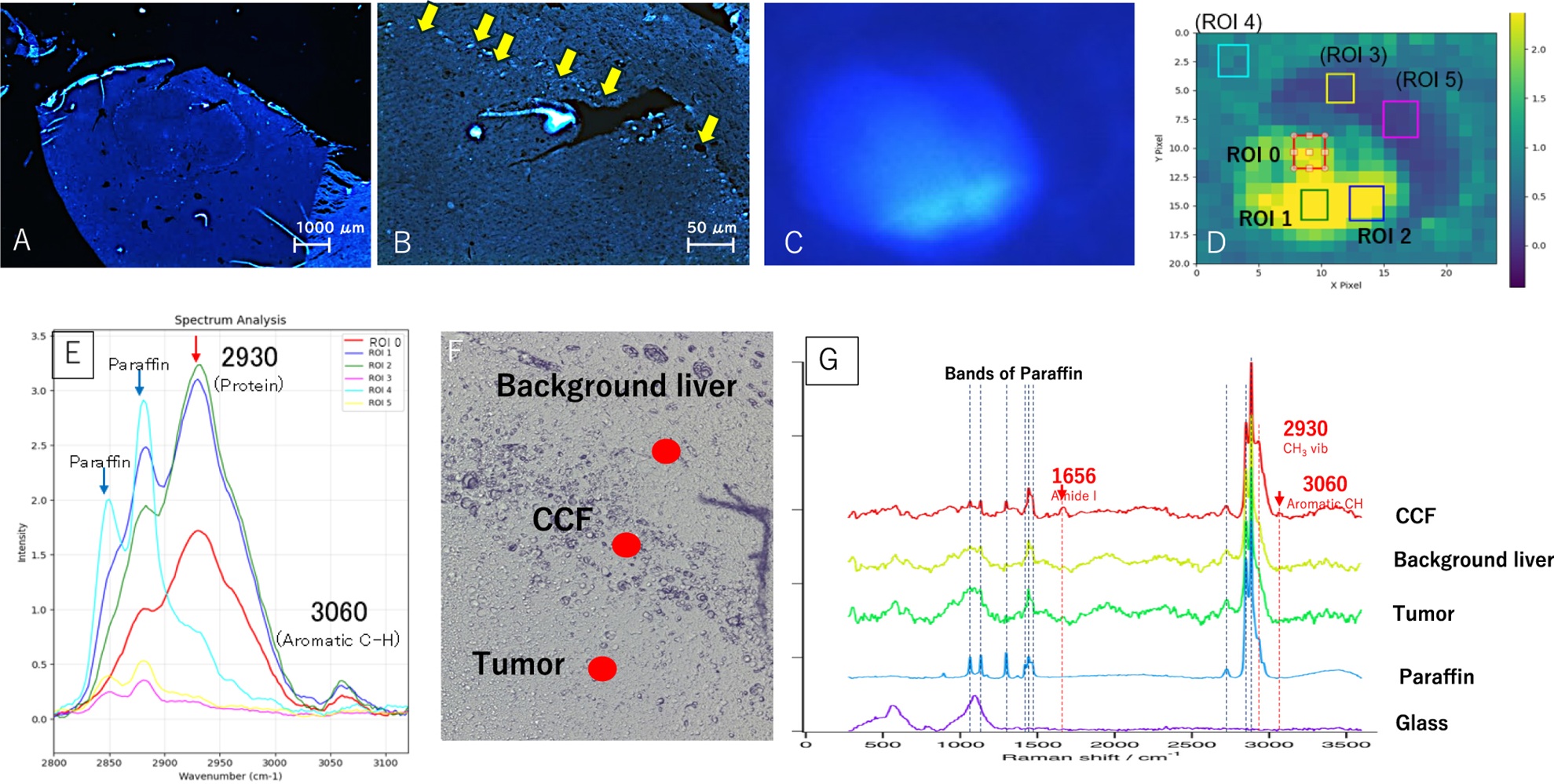 Clear Cell Foci as Precursors of Hepatocyte Nuclear Factor 1-alpha–inactivated Hepatocellular Adenoma in a Metabolic Syndrome Mouse Model